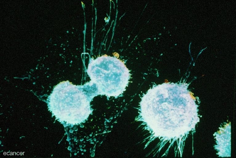 Ovarian cancer cells dividing. Credit: ecancer Ovarian cancer cells dividing. Credit: ecancer