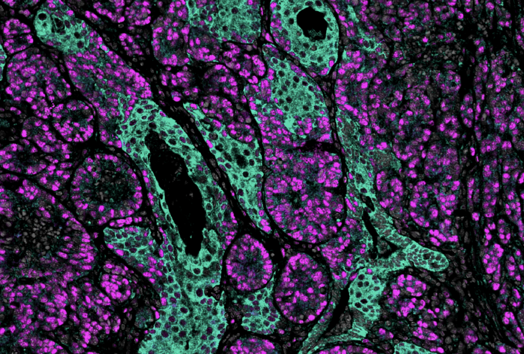 Prostate cancer cells with low levels of PKCλ/ι (turquoise) show increased EZH2 expression (magenta). Credit: Dr. Tania Cid-Diaz