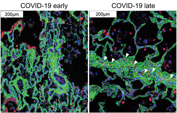 advances-pulmonology-2021-lung-cells-damage