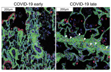 Immune cells (red) migrate near the cells that cause fibrosis (green) in late COVID-19. Images courtesy of André Rendeiro.