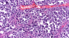 Photo credit: Cancer Discovery 