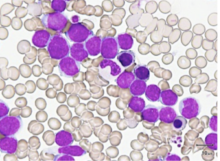 AML Cells