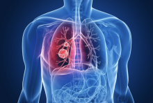 Lung cancer is the leading cause of cancer death worldwide and in the United States. Non-small cell lung cancer accounts for 80 to 85 percent of all lung cancers. Credit: Shutterstock