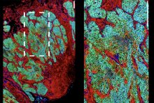 Imaging Mass Cytometry shows the immune-inflamed subtype of upper tract urothelial carcinoma at single-cell resolution. Red: tumor-expressed E-cadherin; Green: T-cell-expressed CD3; Blue: DNA. Credit: Hiranmayi Ravichandran, André Figueiredo Rendeiro and Kentaro Ohara.