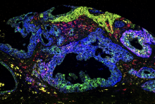 Spatial molecular profiling of a resected pancreatic adenocarcinoma. Fluorescently-labeled probes bind to RNA targets to identify the location of different cell types within a tumor sample. Credit: Jiwoon Park and Rohit Chandwani
