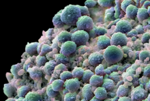 A clump of prostate cancer cells. The blue-green cells are growing, whereas the pink ones are dying by programmed cell death (apoptosis). Credit: Dave McCarthy and Annie Cavanagh/Wellcome Trust A clump of prostate cancer cells. The blue-green cells are growing, whereas the pink ones are dying by programmed cell death (apoptosis). Credit: Dave McCarthy and Annie Cavanagh/Wellcome Trust