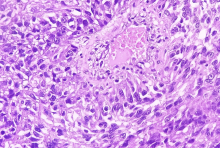 Microscopic image of metastatic clear cell carcinoma of kidney, the most common type of renal cell carcinoma. Credit: Shutterstock