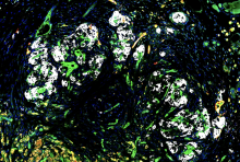 The figure shows a stained graft which was retrieved six weeks after islet and reprogrammed vascular endothelial cell (R-VEC) co-transplantation. The white islet, revealed by insulin staining, is vascularized by green blood vessels derived from co-transplanted R-VECs, which are connected to host blood vessels (red). Credit: Dr. Ge Li