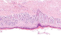 Melanoma @David A. Litman Stock.Adobe.com